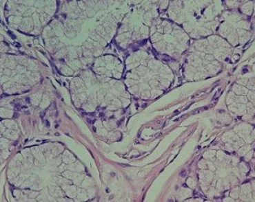 Хронический гастрит: о чем расскажет патоморфологический анализ на Helicobacter Pylori