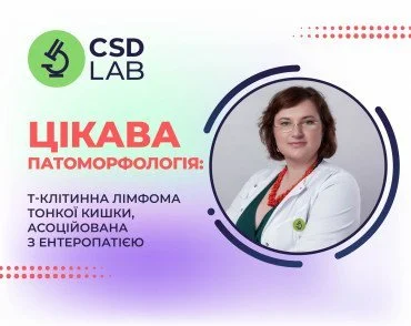 Случай месяца: Т-клеточная лимфома тонкой кишки, ассоциированная с энтеропатией