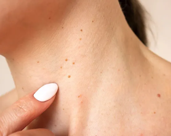 Вірус папіломи людини