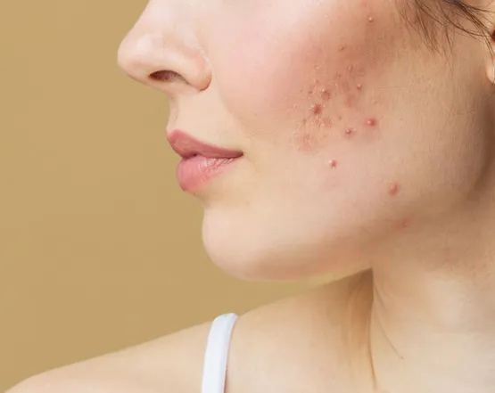 acne