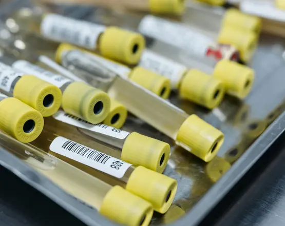 urine analysis