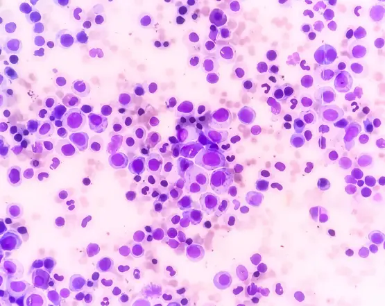 leukemia