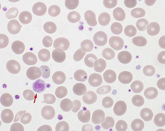Myelodysplastic