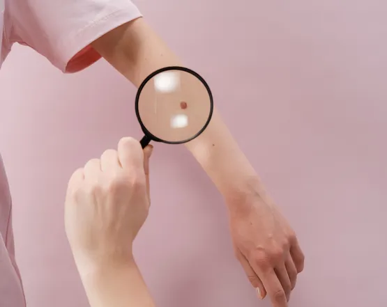 Melanoma