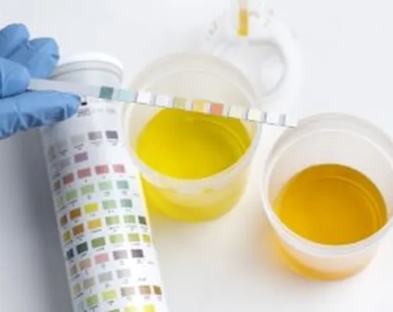 urine analysis