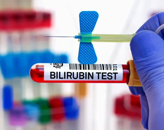 bilirubin-test