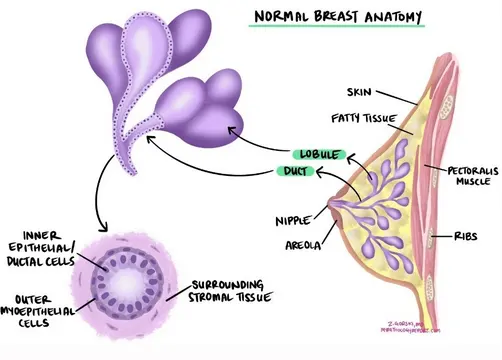 Протокова карцинома