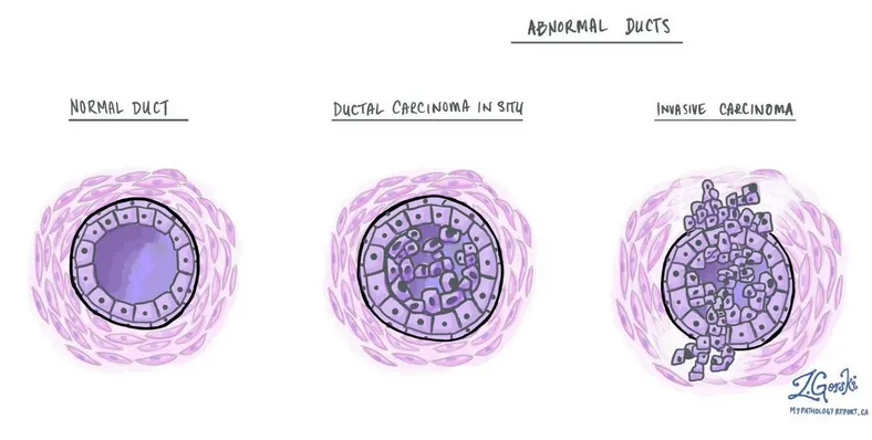 Протокова карцинома