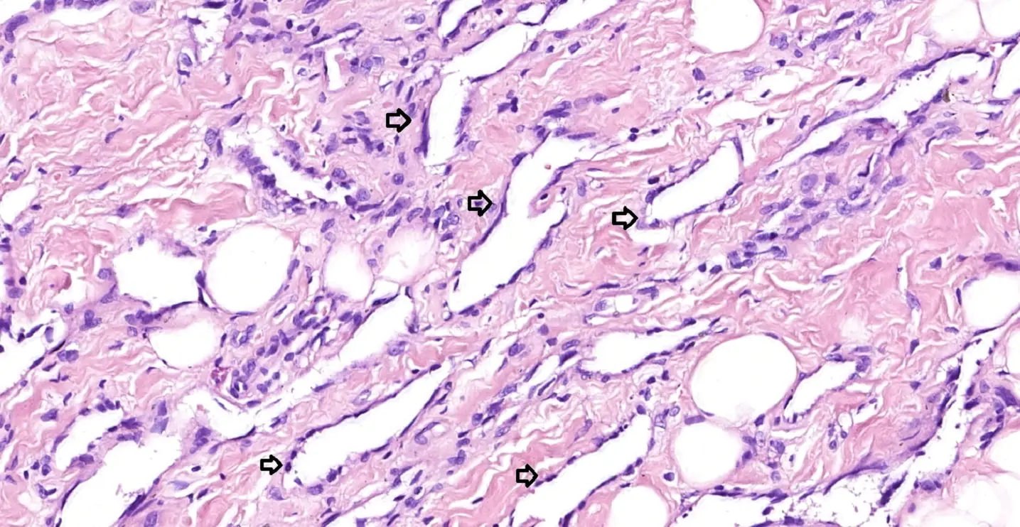 Рис. 3. Стрілками відзначені просвіти пухлинних судин. Ендотеліальні клітини сплощені, непомітні ядра, можна виявити клітини з гіперхромними ядрами, ядерна атипія мінімальна. 