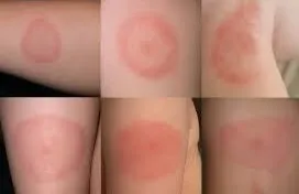 Borrelia