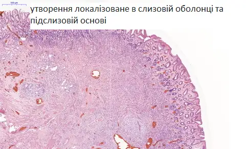 утворення локалізоване в слизовій оболонці та підслизовій основі CSD Lab