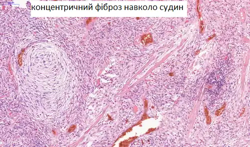 концентричний фіброз навколо судин CSD Lab