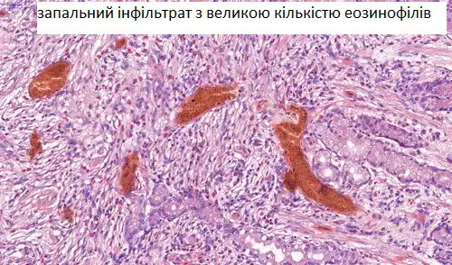 запальний інфільтрат з великою кількістю еозинофілів CSD Lab