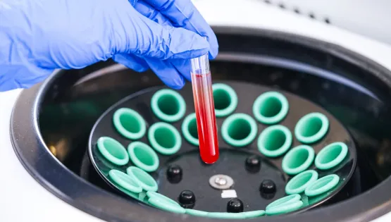 Загальний аналіз крові (лейкоцитарна формула + ШОЕ + морфологія еритроцитів)