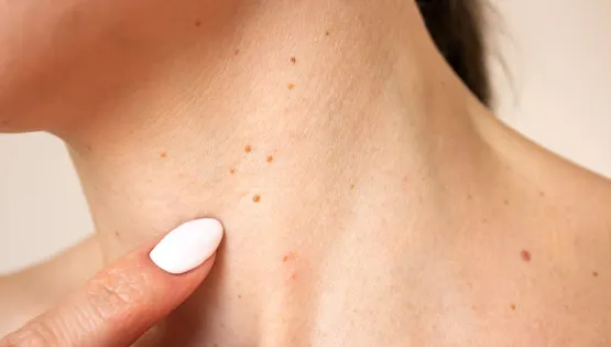 Вірус папіломи людини