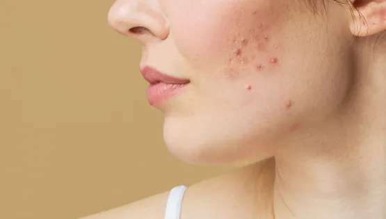 acne