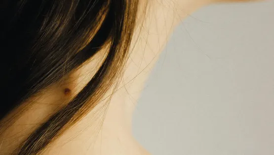 melanoma