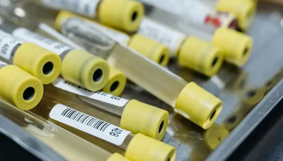 urine analysis
