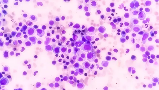 leukemia