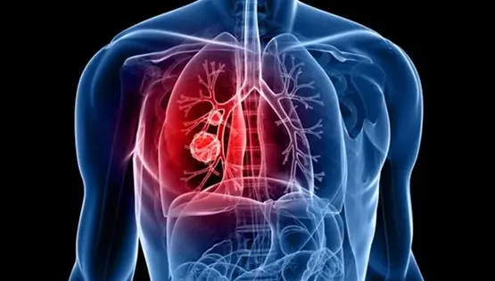 lung cancer