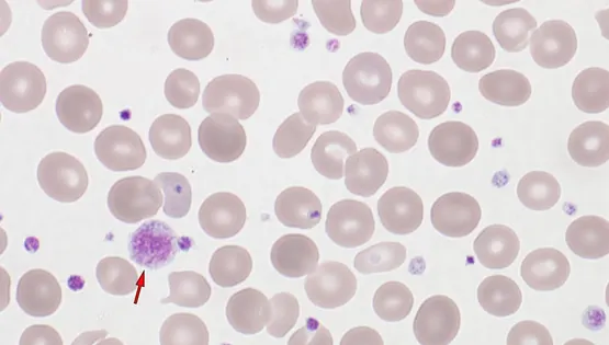 Myelodysplastic