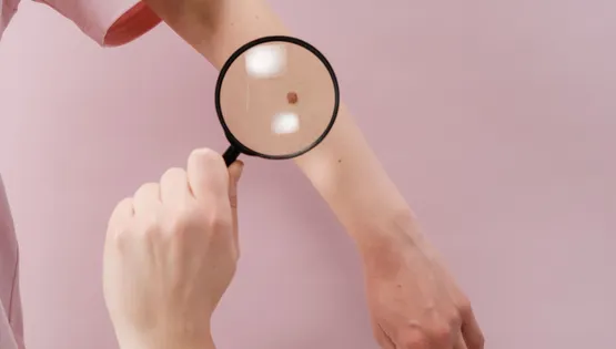 Melanoma
