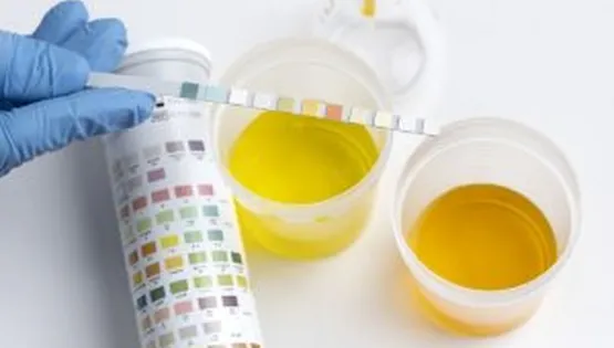 urine analysis
