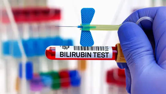 bilirubin-test