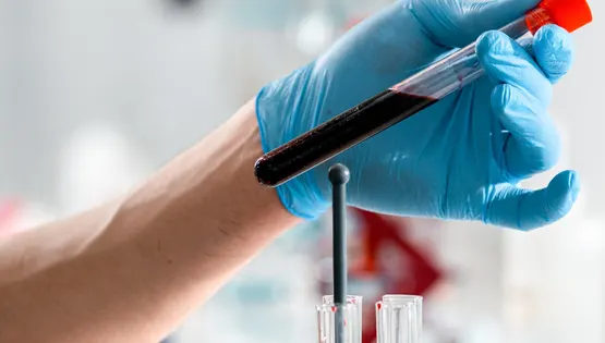 Метаболічний синдром крізь призму андрогенів